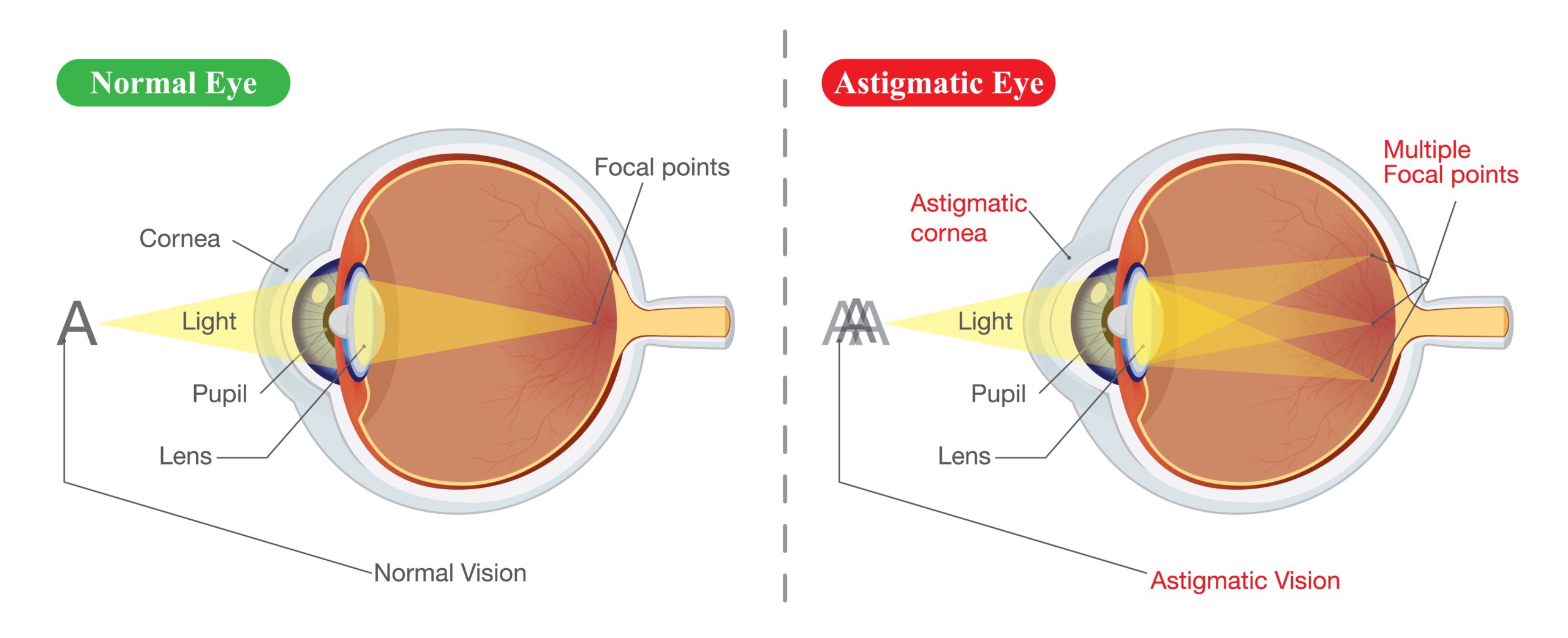 The,Different,Between,Vision,Of,Normal,Eye,And,Astigmatic.,Illustration
